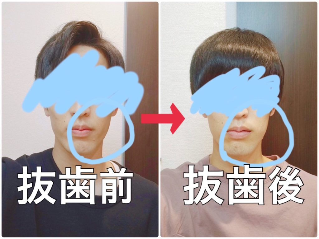 抜い た 後 親知らず